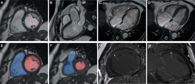 Reversibility of Cardiac Involvement in Acromegaly Patients After Surgery: 12-Month Follow-up Using Cardiovascular Magnetic Resonance